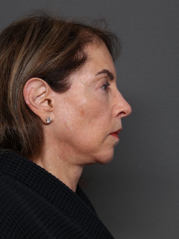 Facelift Before & After Image