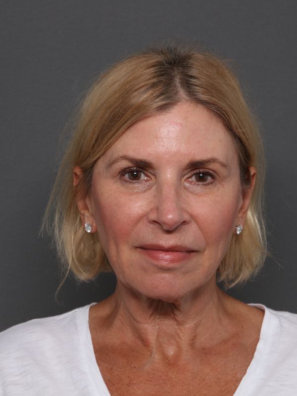 Facelift Before & After Image