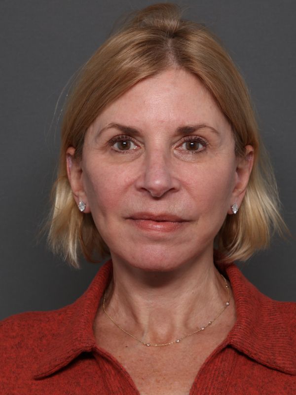 Facelift Before & After Image