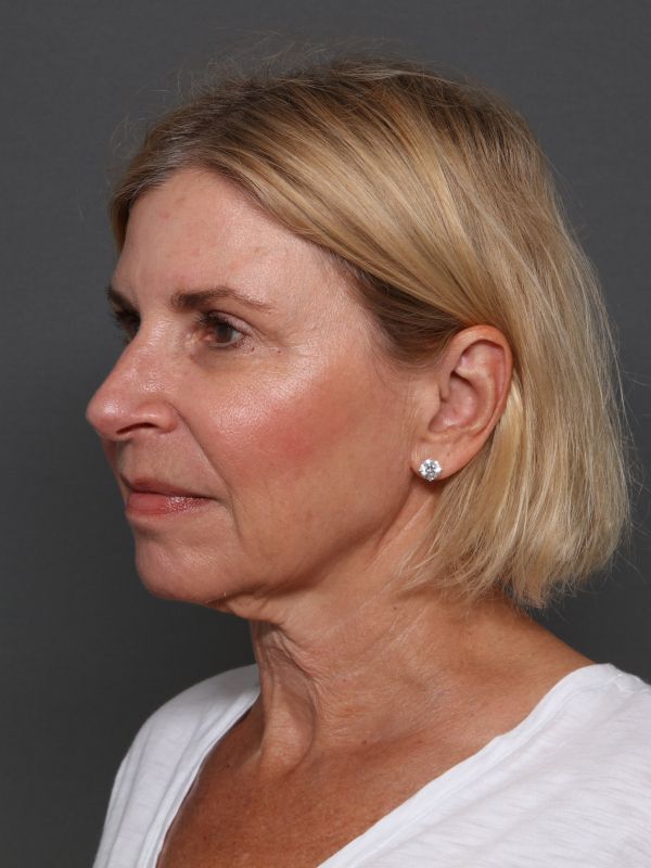 Facelift Before & After Image