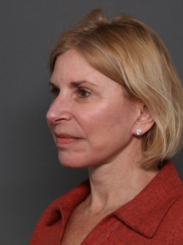 Facelift Before & After Image