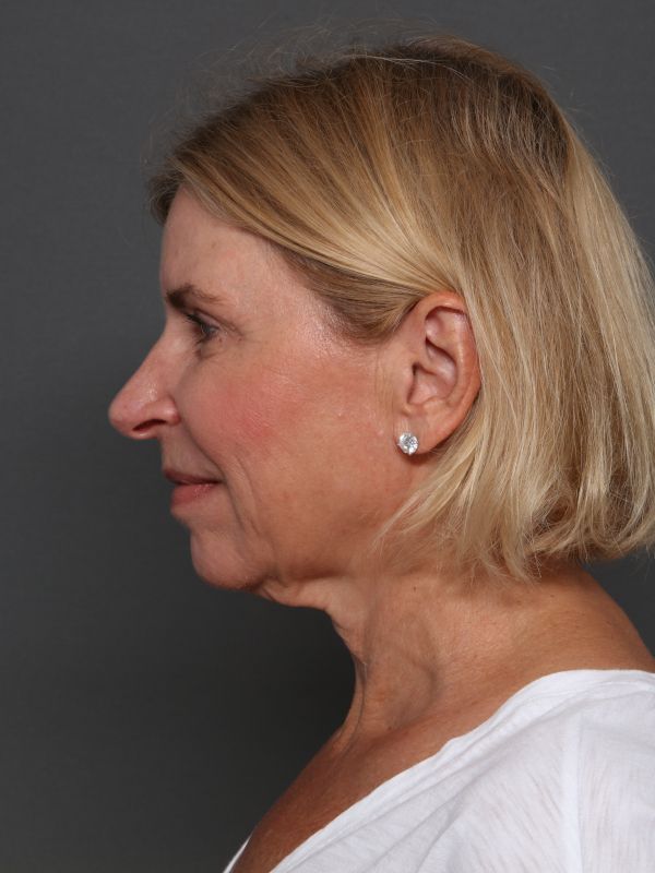 Facelift Before & After Image