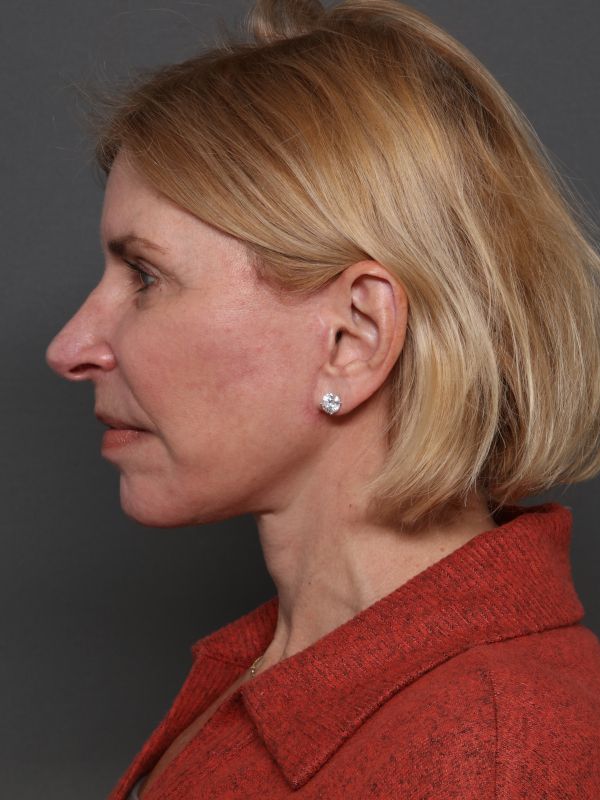 Facelift Before & After Image