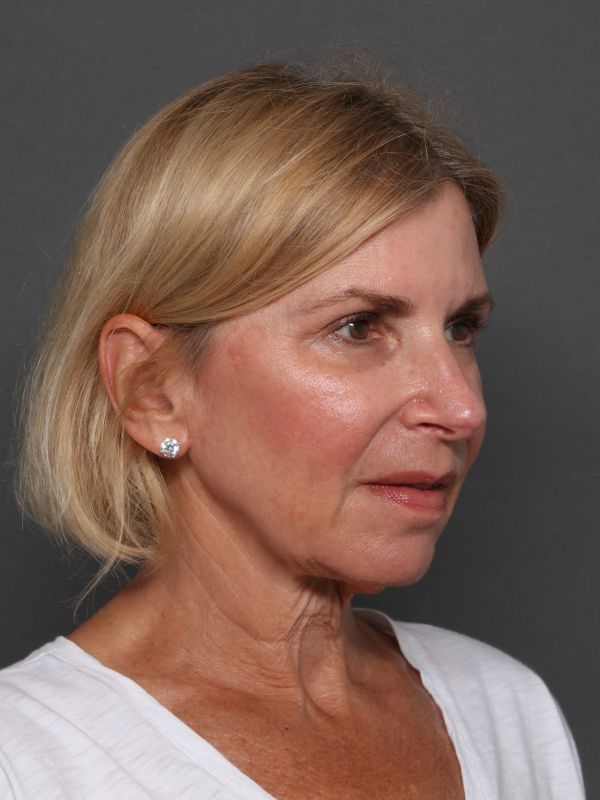 Facelift Before & After Image