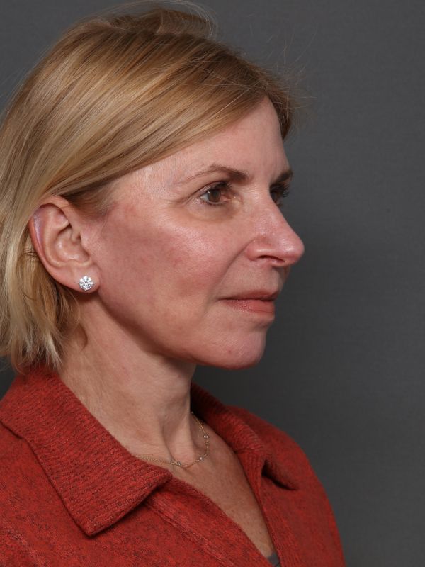 Facelift Before & After Image