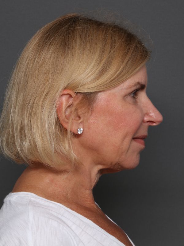 Facelift Before & After Image