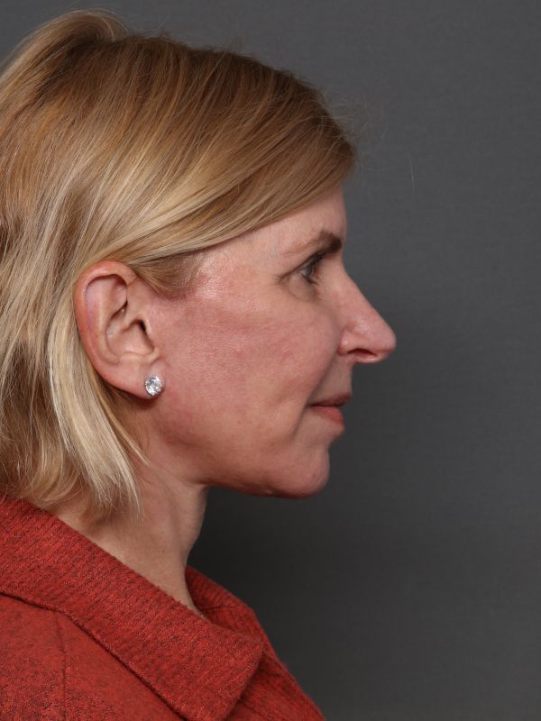 Facelift Before & After Image