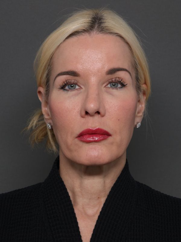 Facelift Before & After Image