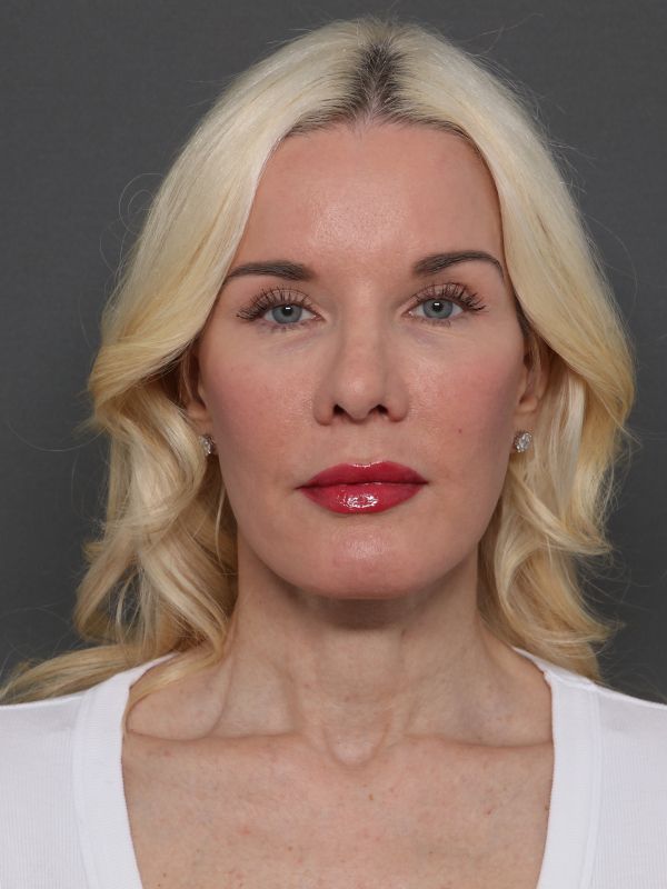 Facelift Before & After Image
