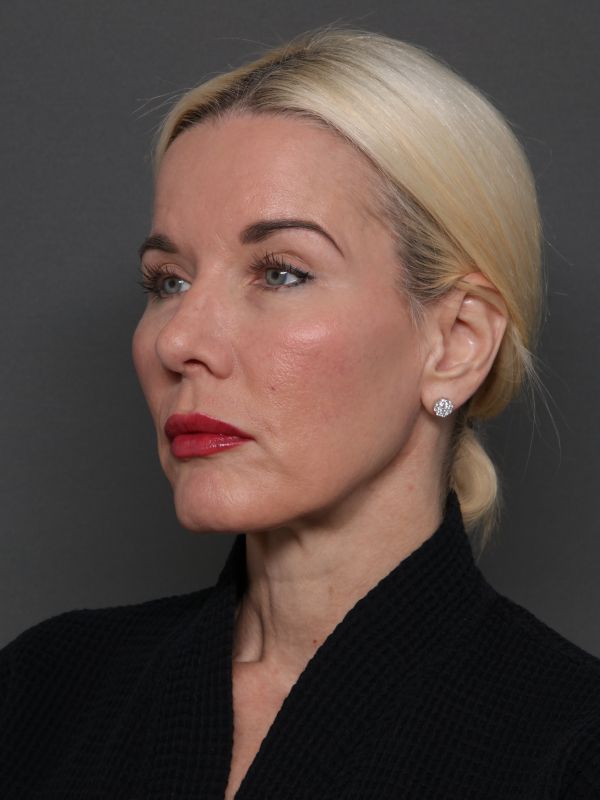 Facelift Before & After Image
