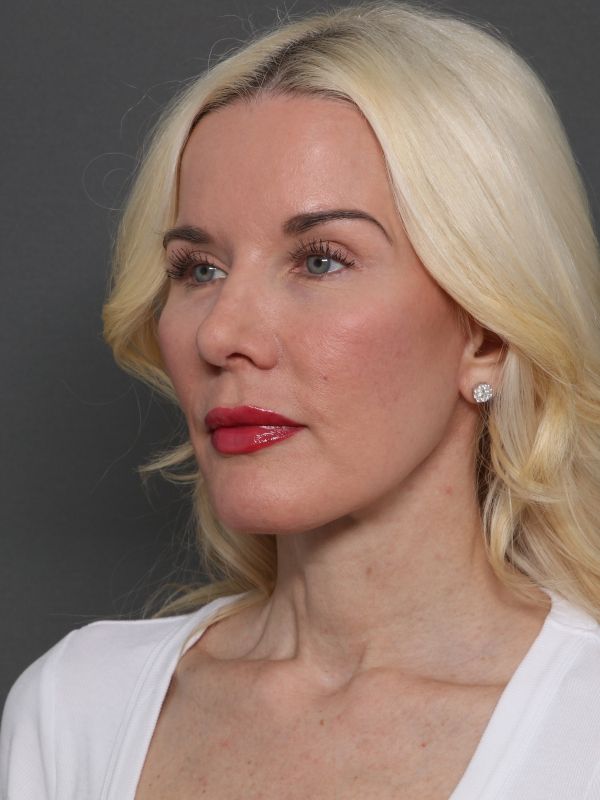 Facelift Before & After Image