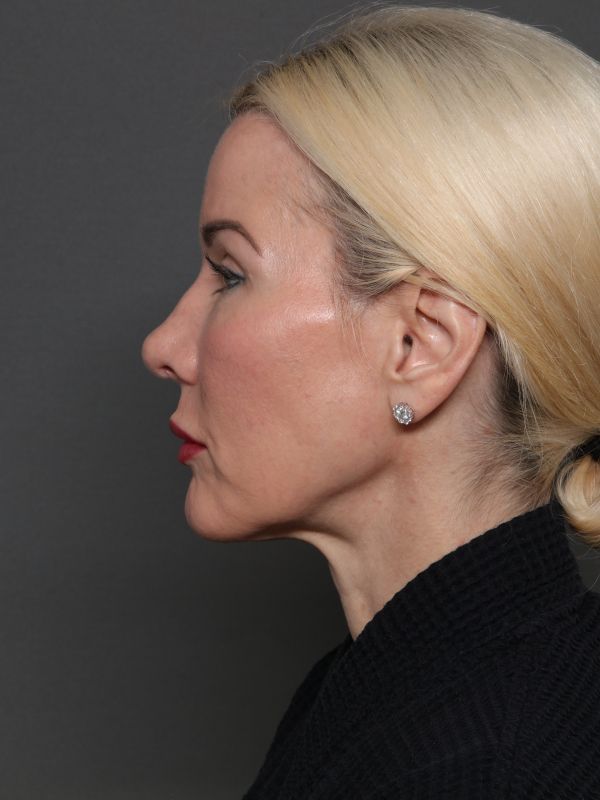 Facelift Before & After Image