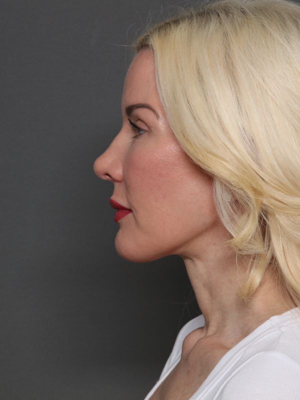 Facelift Before & After Image