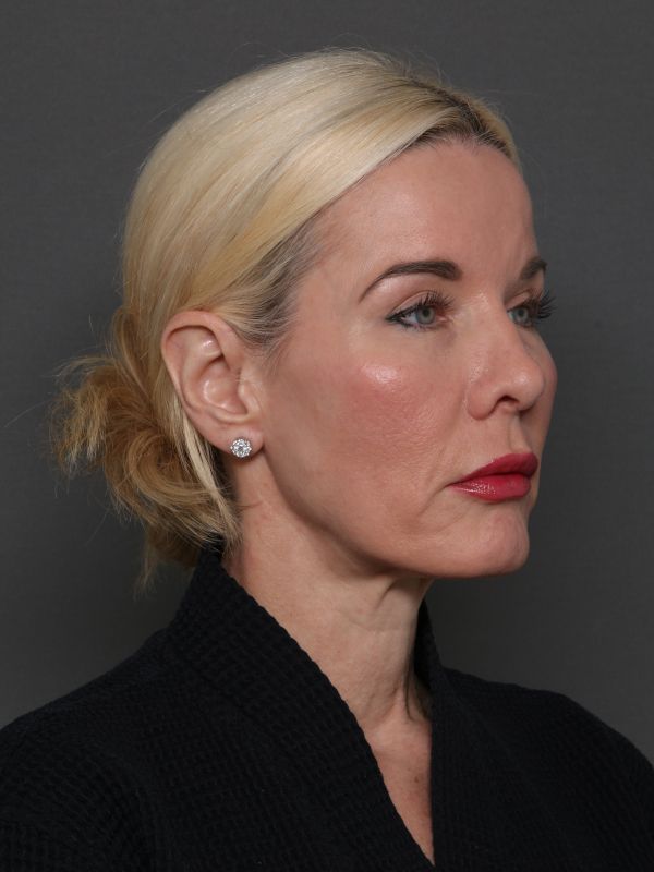 Facelift Before & After Image