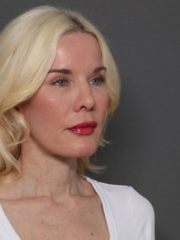 Facelift Before & After Image