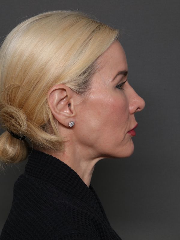 Facelift Before & After Image