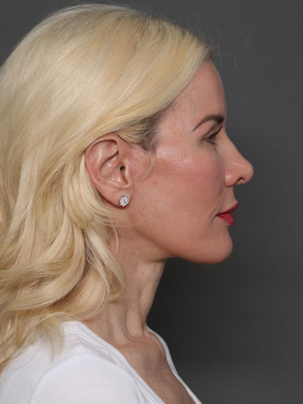 Facelift Before & After Image