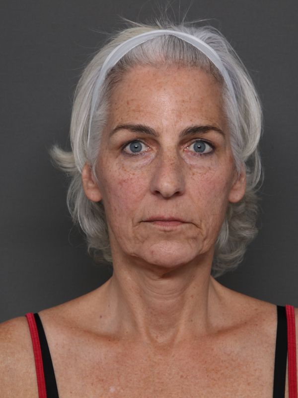 Facelift Before & After Image
