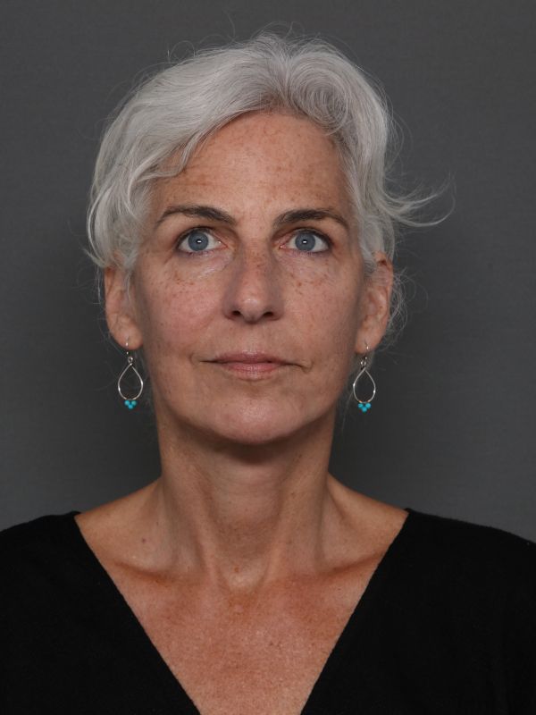 Facelift Before & After Image