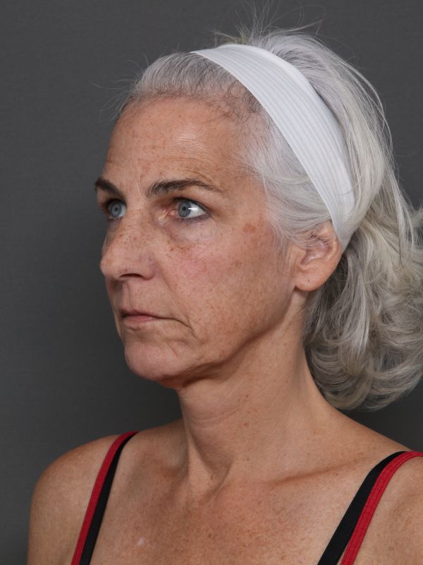 Facelift Before & After Image