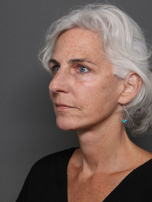 Facelift Before & After Image