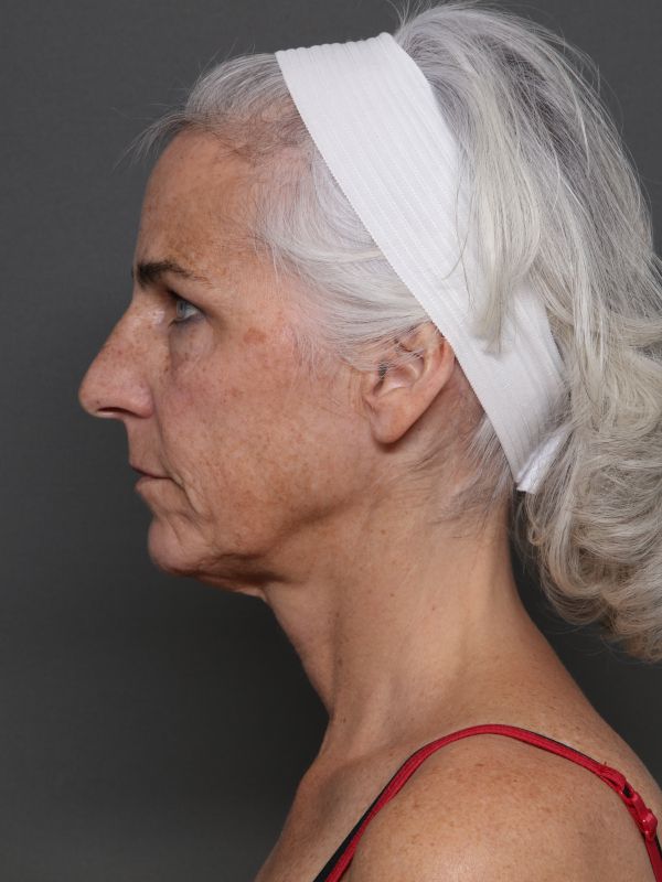 Facelift Before & After Image