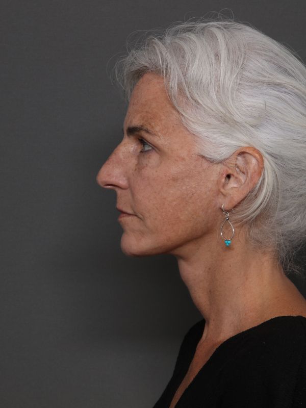 Facelift Before & After Image