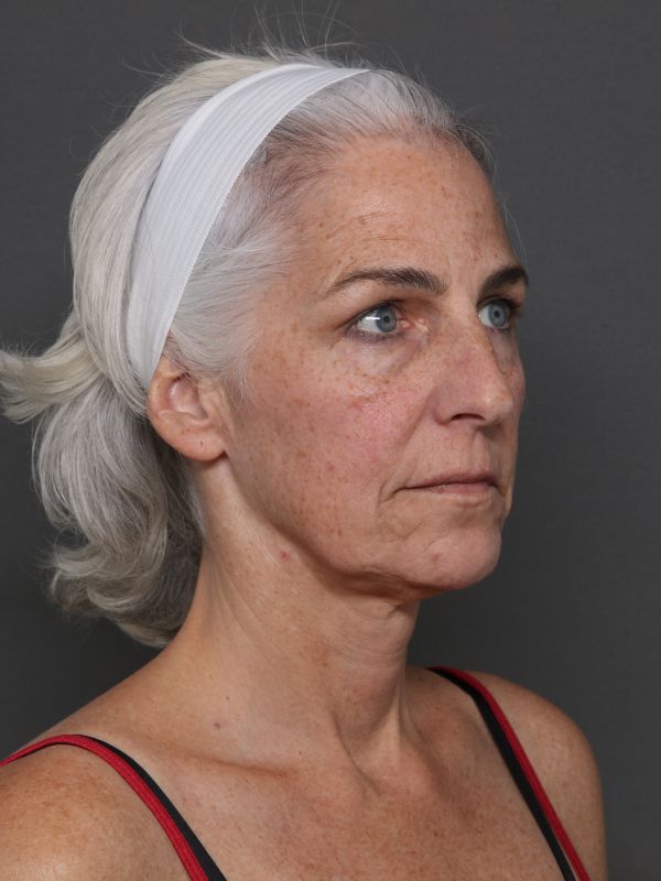 Facelift Before & After Image