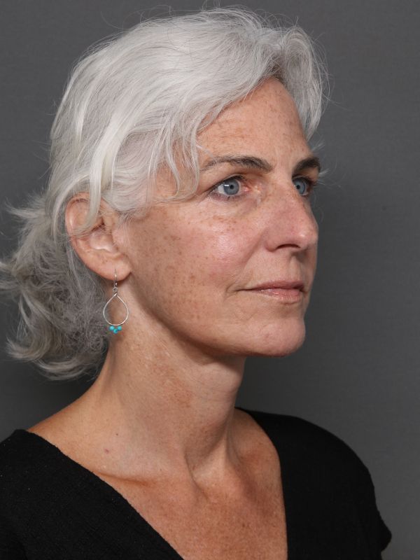 Facelift Before & After Image