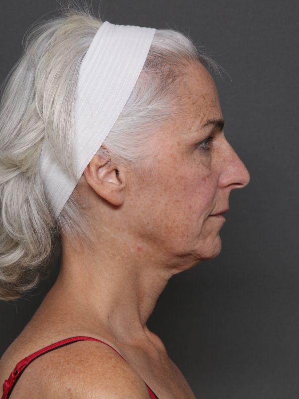 Facelift Before & After Image