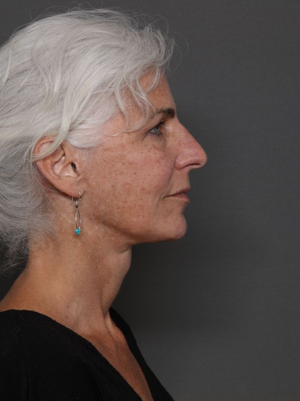 Facelift Before & After Image