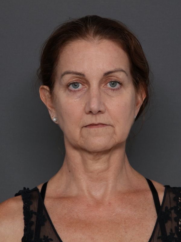 Facelift Before & After Image