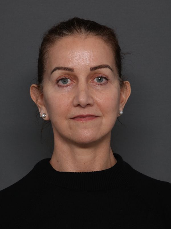 Facelift Before & After Image
