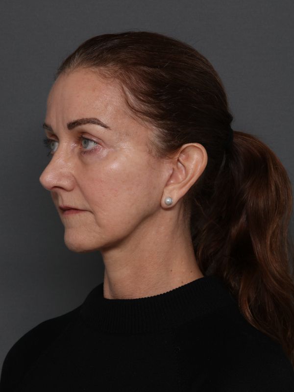 Facelift Before & After Image
