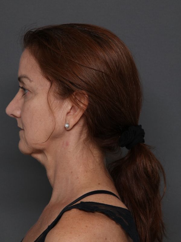 Facelift Before & After Image
