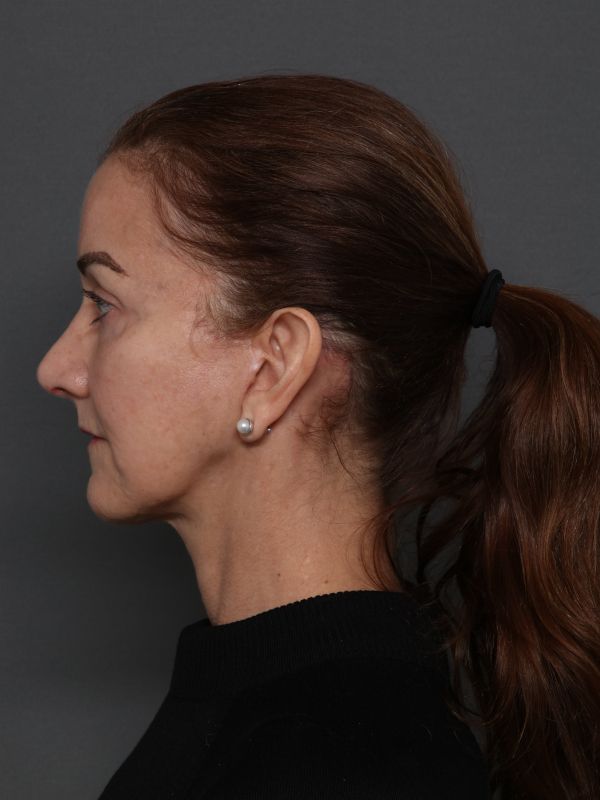 Facelift Before & After Image