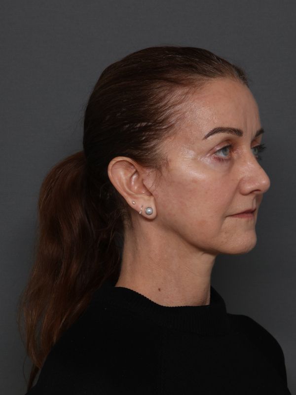 Facelift Before & After Image