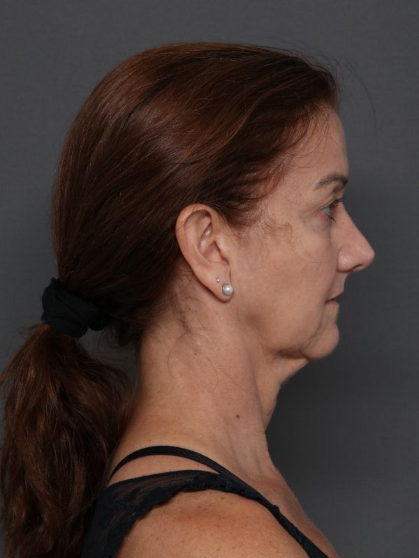 Facelift Before & After Image