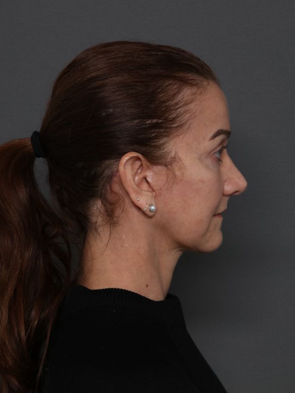 Facelift Before & After Image