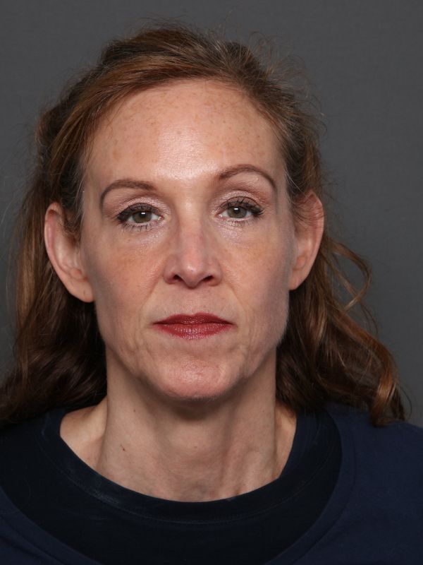 Facelift Before & After Image