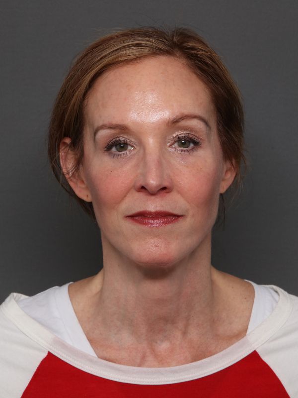 Facelift Before & After Image