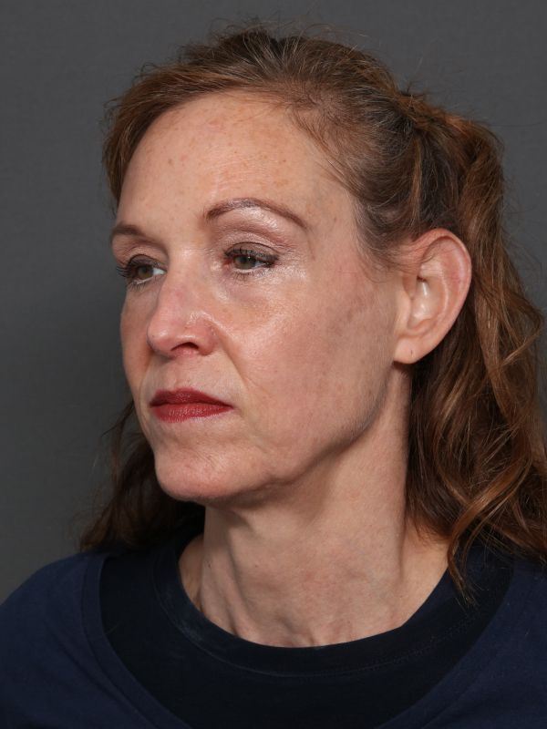 Facelift Before & After Image