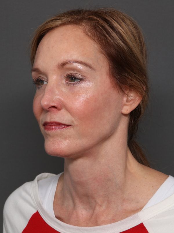 Facelift Before & After Image