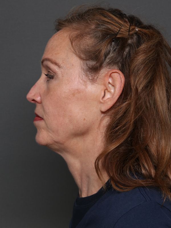 Facelift Before & After Image