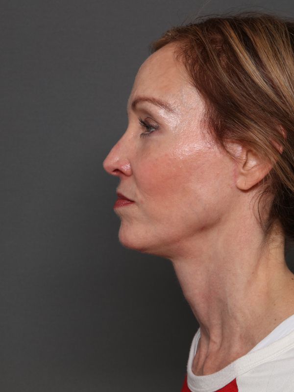 Facelift Before & After Image
