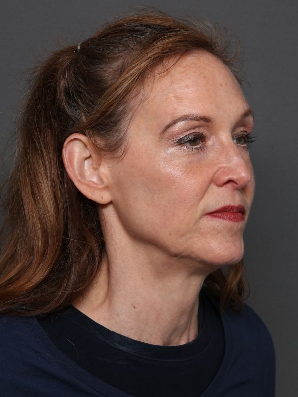 Facelift Before & After Image