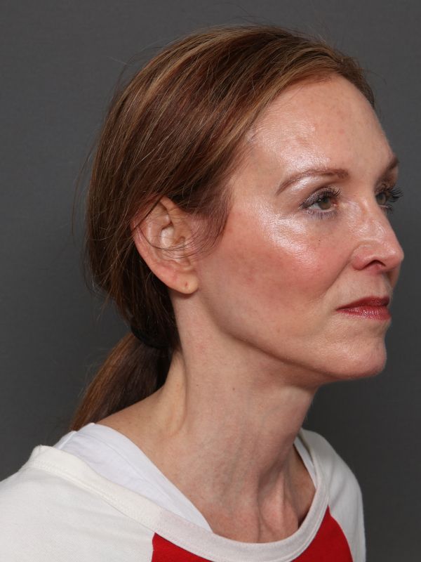 Facelift Before & After Image