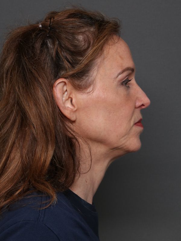 Facelift Before & After Image