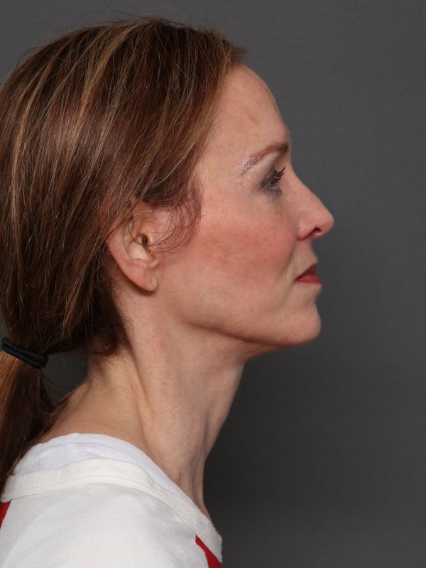 Facelift Before & After Image