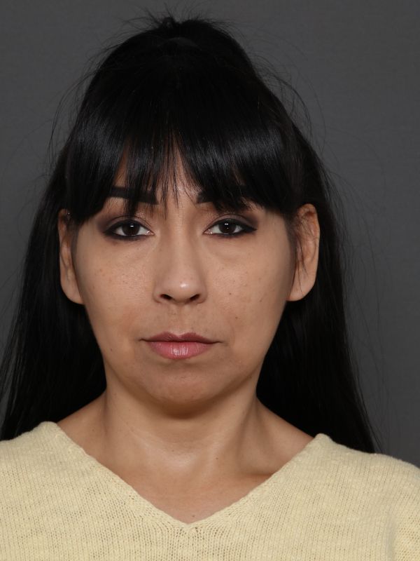 Facelift Before & After Image